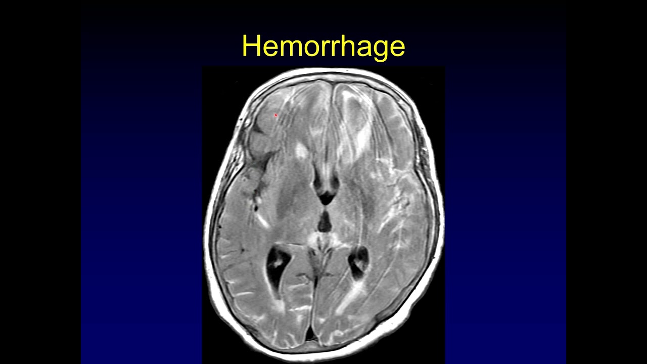 Диффузная бороздчатая аномалия сигнала FLAIR