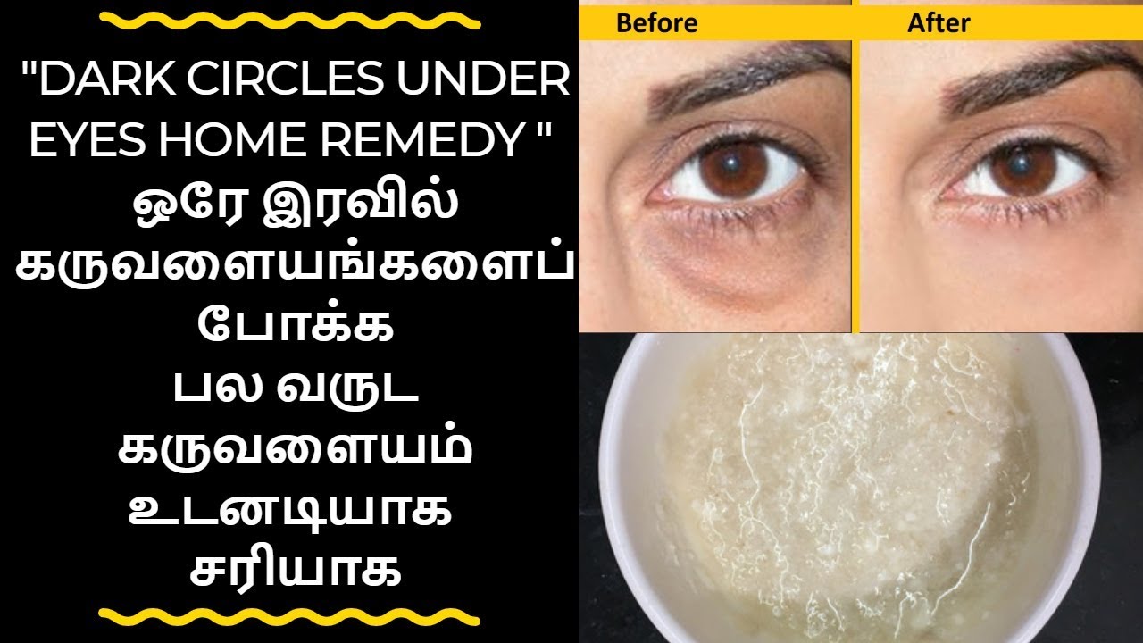 Karuvalayam Poga Tips Tamil / Dark Circles Under Eyes Home Remedy In