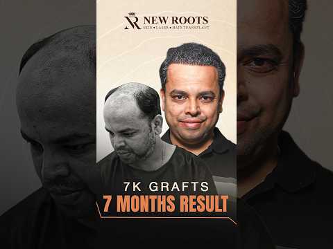 Hair Transplant in Mumbai (Grade 6 Baldness) | Marathi #hairtransplant #mumbai #shorts