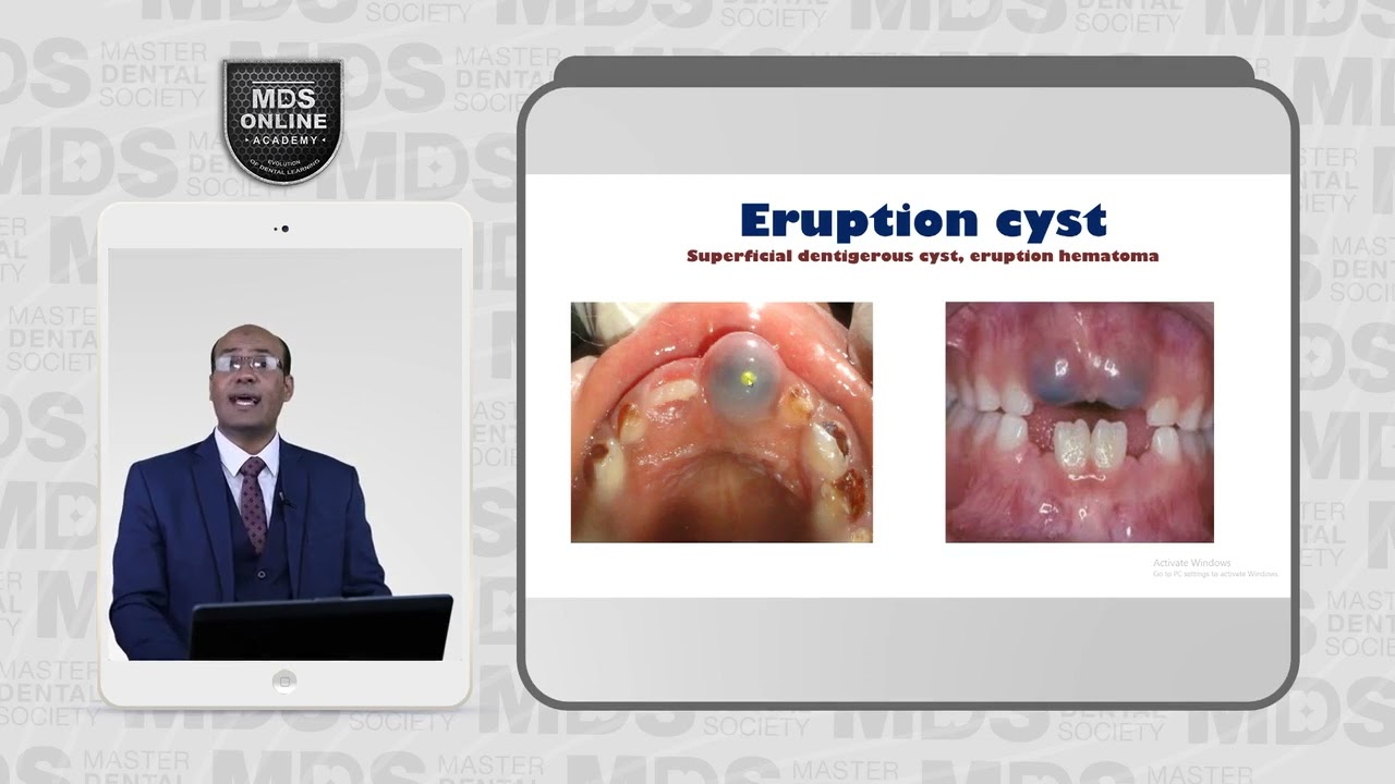 5 2 Dentigerous cyst Varient Eruption Cyst    6 1 Lateral Periodontal Cyst