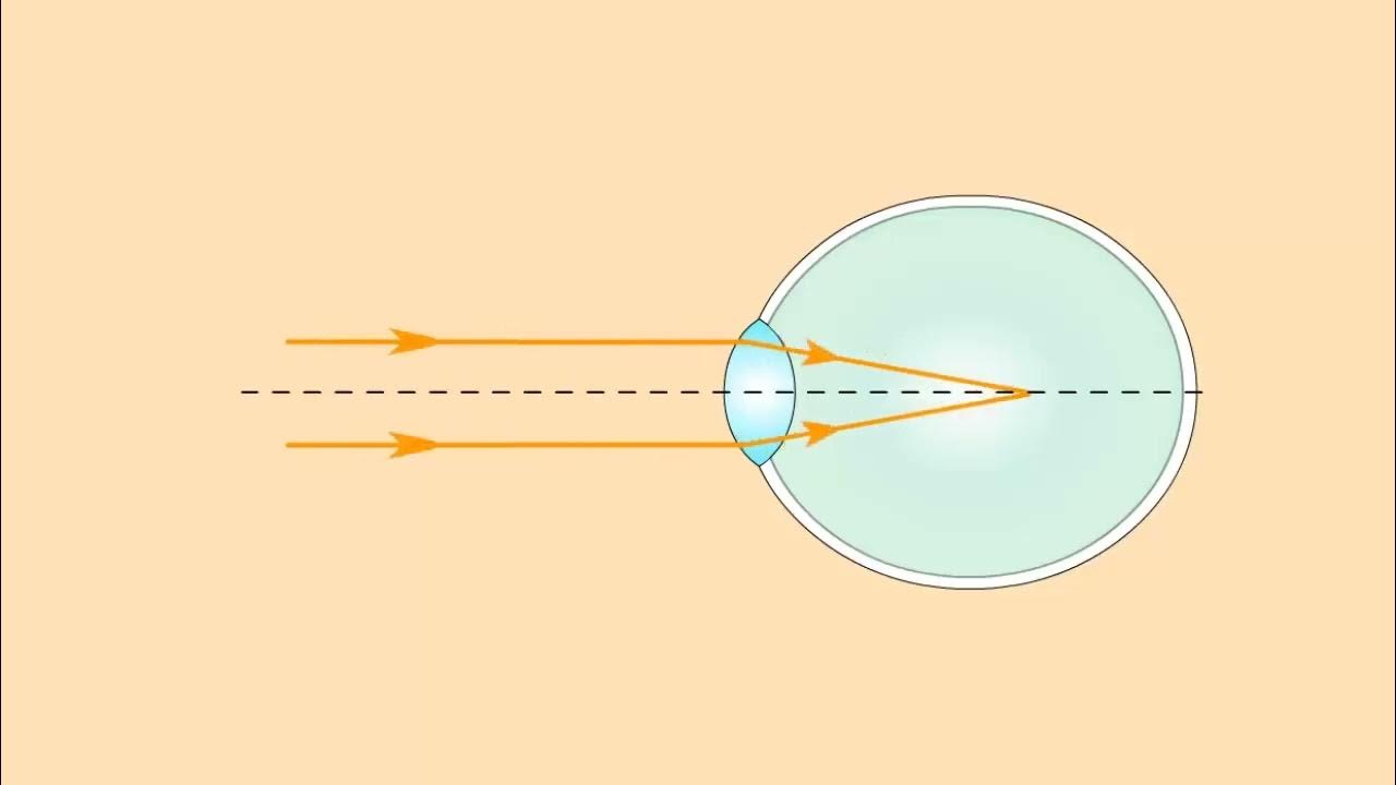 Ход лучей глаза человека. Дефекты зрения близорукость. Близорукость и дальнозоркость физика. Близорукий глаз физика. Форма линз для дальнозорких.
