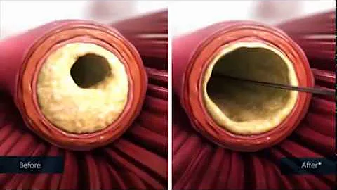 Peripheral Arterial Disease Atherectomy at CVI in Southern California