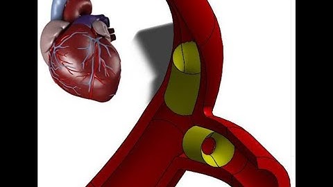 Coronary artery FSI simulation (CFD); heart disease; atherosclerosis