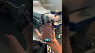 The "Hidden" Danger of Frostbite! 😱