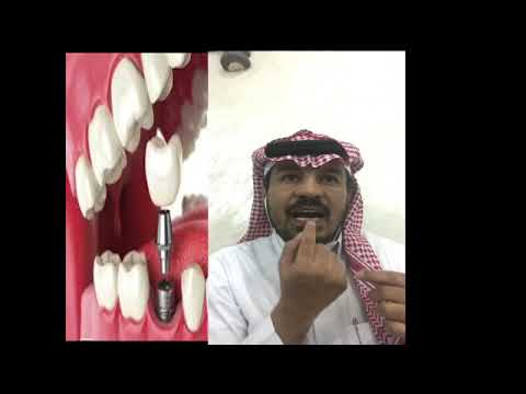 تفسير حلم سقوط الاسنان