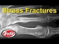 Foot Stress Fracture Relief