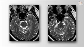 Variation of Vascular Compression in Trigeminal Neuralgia (Preview)
