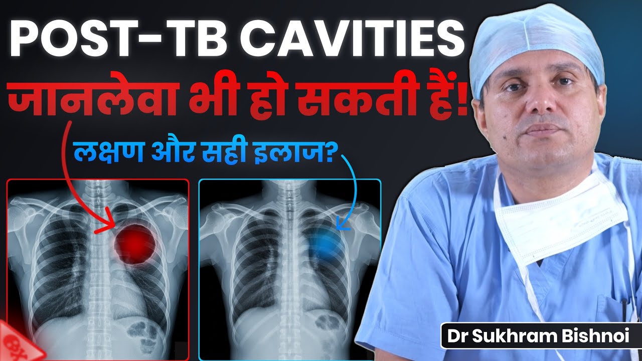 TB के इलाज के बाद खांसी में खून? हो सकता है खतरनाक Fungal Ball (Aspergilloma) | Dr Sukhram Bishnoi