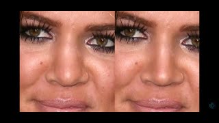 Dr Bader NOSE Hollywood, episode 7: Khloe Kardashian