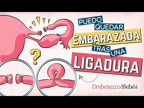 Video: ¿Puedes quedar embarazada naturalmente sin las trompas de Falopio?