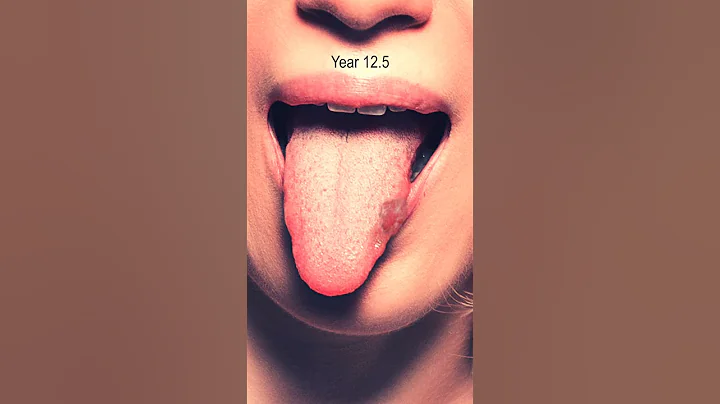 Tongue Cancer Time Lapse - DayDayNews