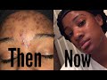 How I Tamed My Acne/Dark Spots || Skin Care Routine!!