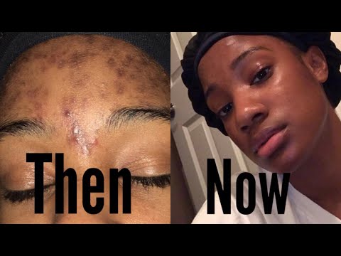 How I Tamed My Acne/Dark Spots || Skin Care Routine!!