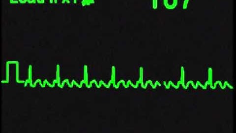Atrial Flutter 3:1 - ECG Simulator - Arrhythmia Simulator