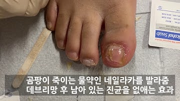 약 1년 먹어도 안 낫는 발톱 무좀 완치 - 건강보험 적용되는 주 1회 시술을 꾸준히 받으면 됨