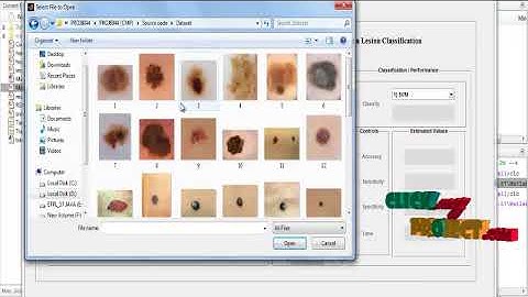 A 3D Reconstruction Technique for Computerized Dermoscopic Skin Lesion Classification