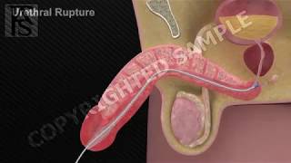 Urethral Rupture