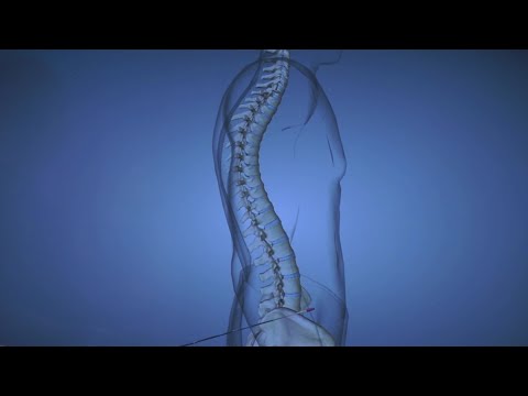 Spine Disease: Kyphosis