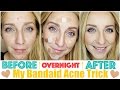 How to Get Rid of Acne Fast & OVERNIGHT with My Bandaid Trick!