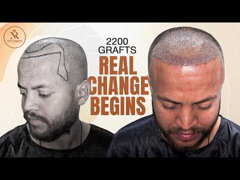 New Hairline Loading… 🔥 Grade 3 Baldness | Hair Transplant in Raipur | New Roots
