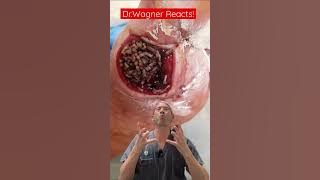 MAGGOT THERAPY: PART 2 🐛#shorts #woundcare