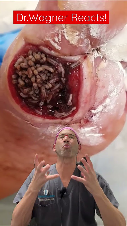 MAGGOT THERAPY: PART 2 🐛#shorts #woundcare