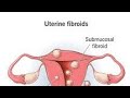 Uterine Fibroids