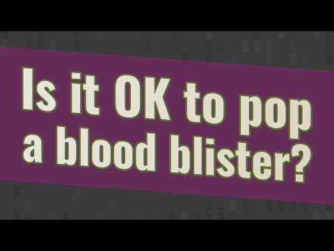 Is it OK to pop a blood blister?