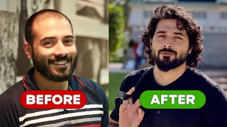 My Remarkable Hair Transplant Journey | From Baldness to Boldness