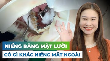 Bạn Nào Bảo Niềng Răng Mặt Lưỡi Khó Chịu Thì Xem Video Này Nhé