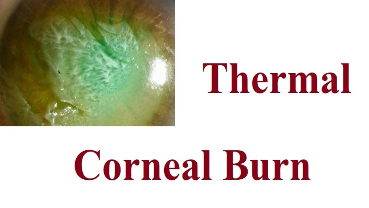 Thermal corneal Burn - YouTube