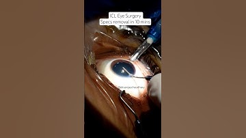 How ICL eye surgery for specs removal is done#icl #iclsurgery #staarevoicl