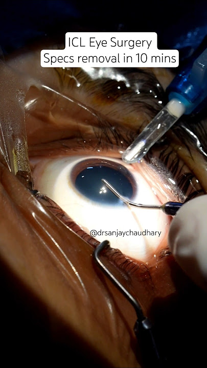 How ICL eye surgery for specs removal is done#icl #iclsurgery #staarevoicl