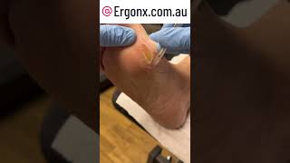 Thick foot callus removal can be so satisfying