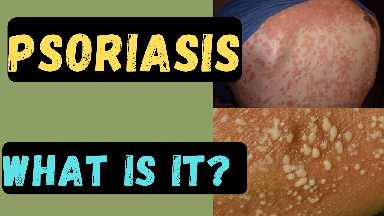 What is Psoriasis | Understanding skin Conditions | Health - YouTube