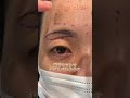 眉下切開だけでもナチュラルに変化🪄#眉下リフト #眉下切開 #美容整形