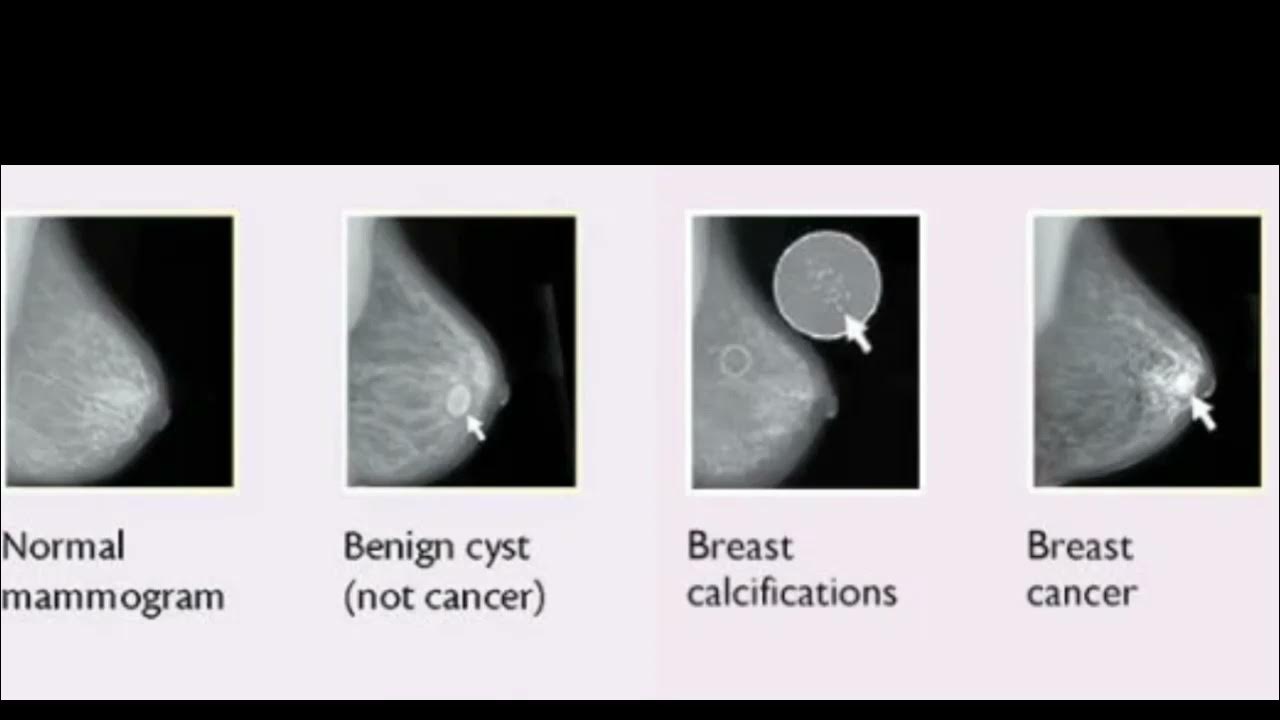 what-does-a-breast-cancer-lump-feel-like-youtube