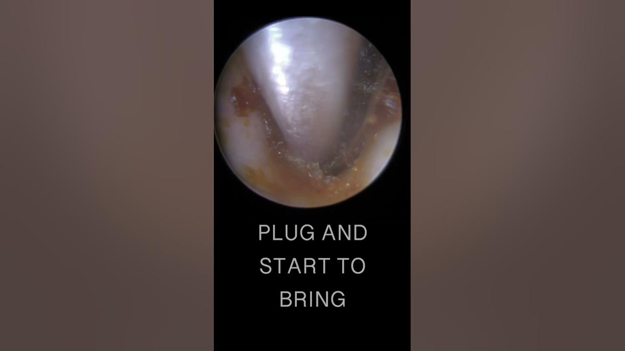 SUPER STICKY DEEP EAR WAX REMOVAL YouTube