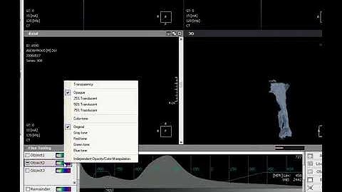 3D Module Airway Segmentation