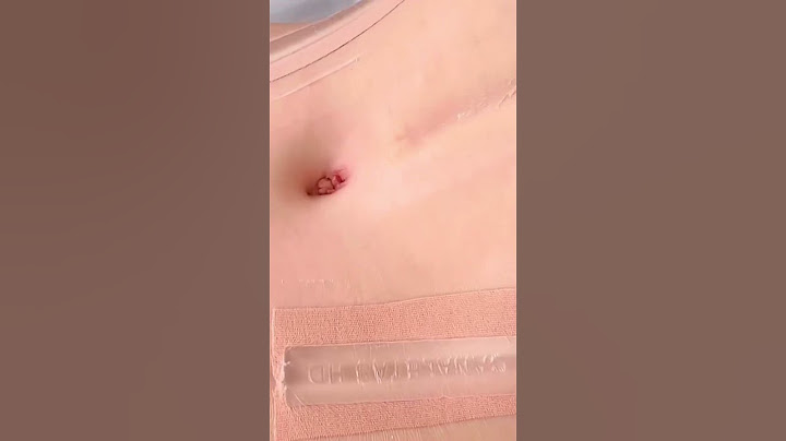 30 dias pós operatório cirurgia plástica de abdominoplastia