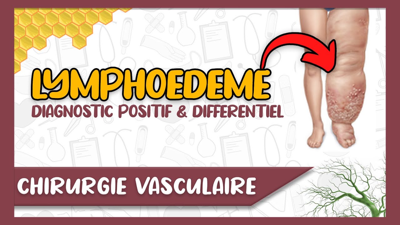 le-lymphoed-me-des-membres-diagnostic-clinique-examens