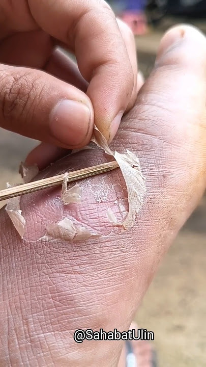 KAKI MANG UNI KETUSUK PAKU BESTIEEE