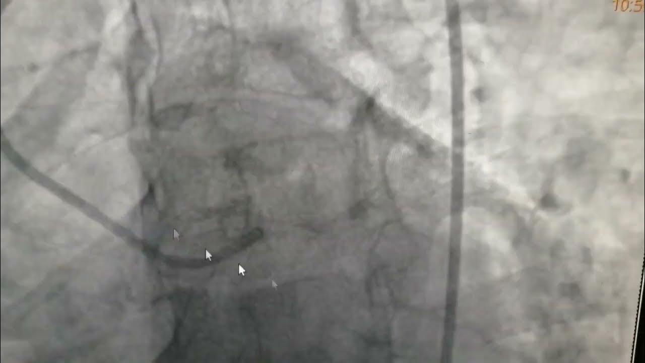 Critical Distal Left Main Stem With Ostial Lad And Lcx YouTube critical-distal-left-main-stem-with-ostial-lad-and-lcx-youtube
