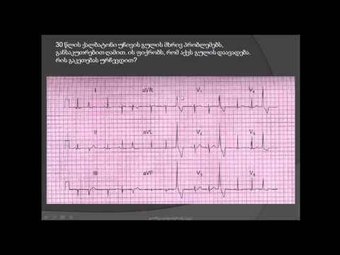 პარკუჭოვანი ექსტრასისტოლა (parkuchovani eqstrasistola, eqstrasistolia). eleqtrokardiogramis garcheva