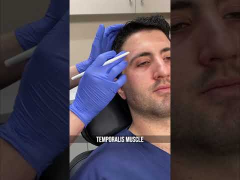 Video: Botox Vīriešiem: Popularitāte, Procedūra, Izmaksas, Nodrošinātāja Atrašana
