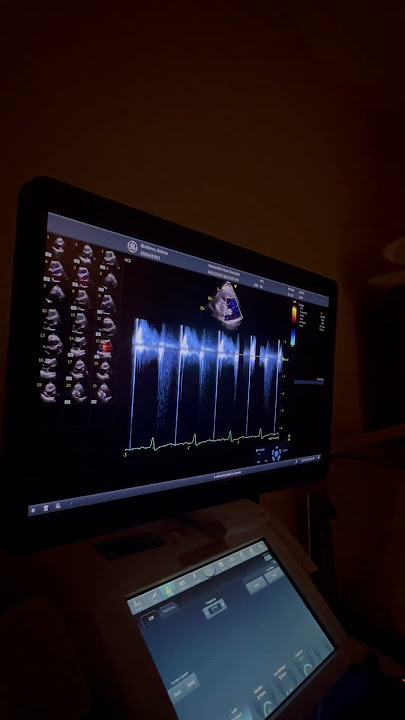 What does a mechanical heart valve sound like on an echo?? #heartwarmingmoments ##chdwarrior #echo