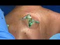 [ASMR] Sharp Ingrown Trimmed! Professional Pedicure DR LEE’S ULTIMATE ZITPOPPER 0509IPX IMG 3614