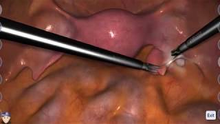 LapSim Gynecology: Ectopic Pregnancy