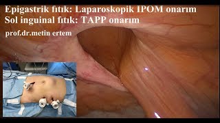 Laparoskopik Epigastrik + Sağ inguinal fıtık onarımı, Prof.Dr.Metin Ertem