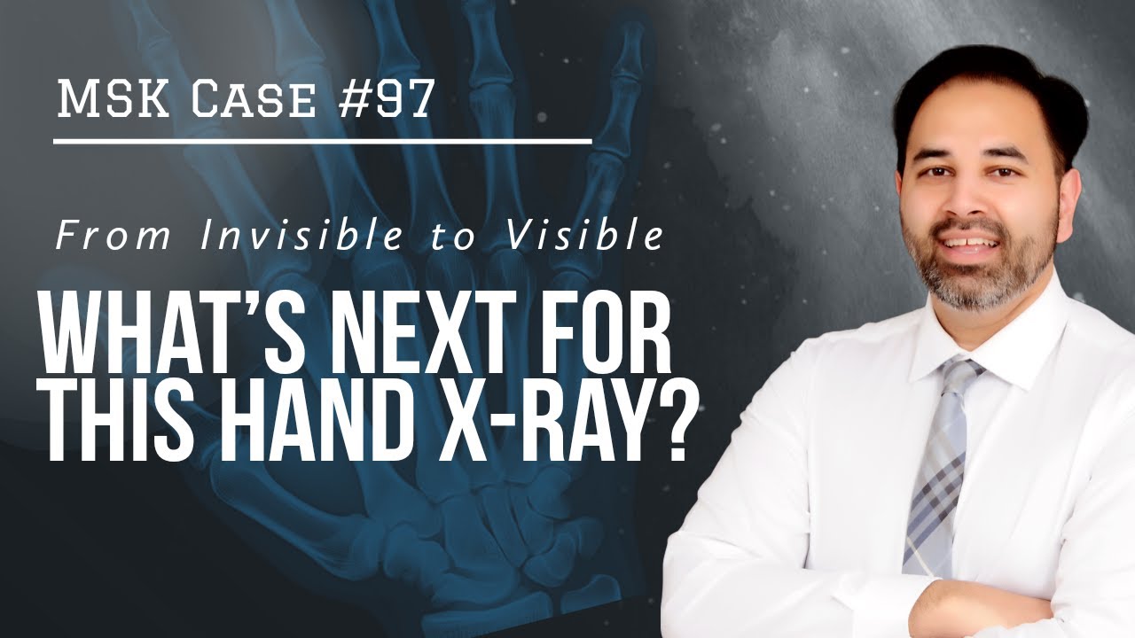 MSK CASE #97- How To Make Sense Of Carpal Instability In The Wrist?